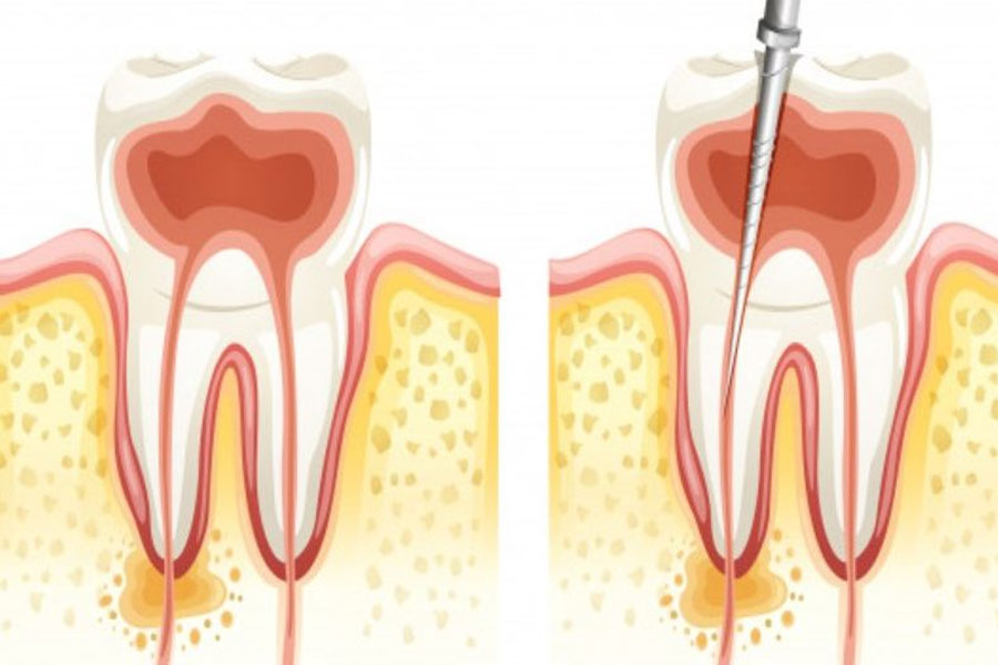 endodontija